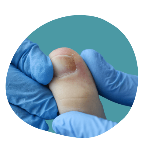 Ingrown toenail treatment in Perth